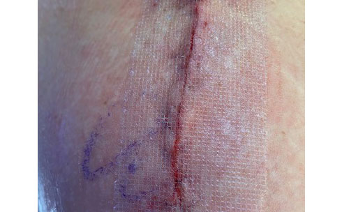 The mesh should stay securely on the incision for 10-14 days.