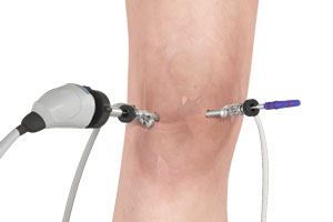 knee arthroscoy