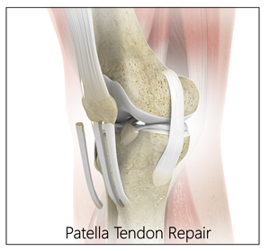 Patellar Tendon Repair