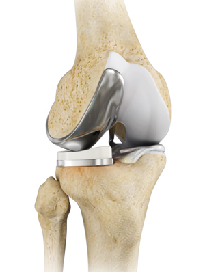 Partial Knee Replacement 