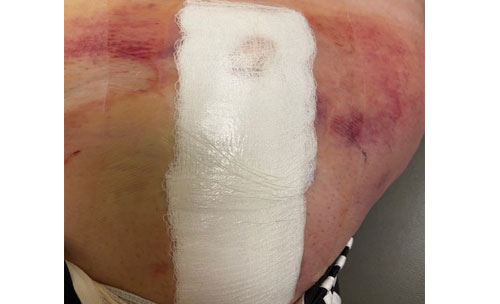 Bruising and slight drainage on the gauze bandage.