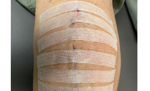 Normal knee wound post-op