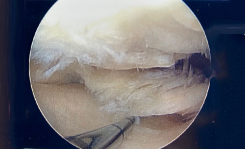 Very large meniscus tear with abnormal cartilage on the bony surfaces.