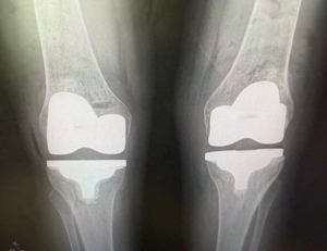 After X-ray