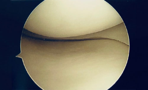 Normal knee with smooth meniscus and smooth cartilage covering the bone surfaces.