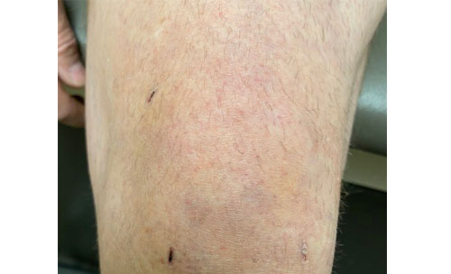 Knee arthroscopy at 2 weeks post-op