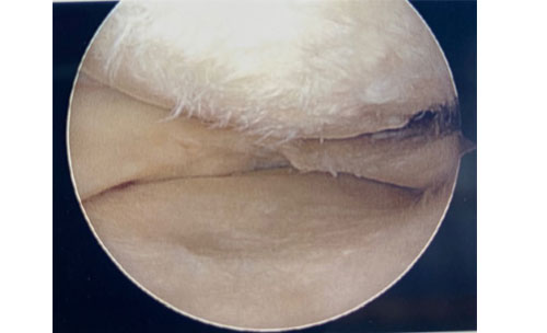 Small meniscus tear with some early arthritis or frayed cartilage covering the bone surfaces.